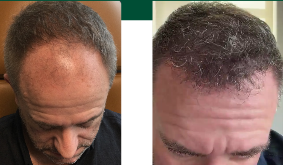 Cody B. - Before & After